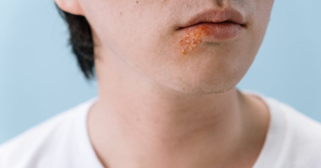 découvrez tout sur l'herpès labial : causes, symptômes, traitements et conseils pour soulager les poussées de boutons de fièvre. protégez-vous et apprenez à mieux gérer cette infection virale gênante.