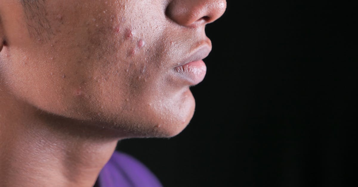 découvrez ce que sont les points blancs (whiteheads), leurs causes, comment les prévenir et les solutions efficaces pour retrouver une peau nette et sans imperfections.
