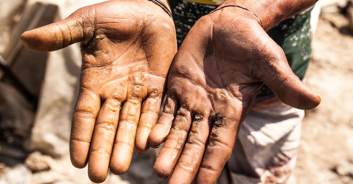 découvrez l'essentiel sur les callosités : causes, symptômes et conseils efficaces pour prévenir ou traiter ces épaississements cutanés généralement causés par des frottements répétés.