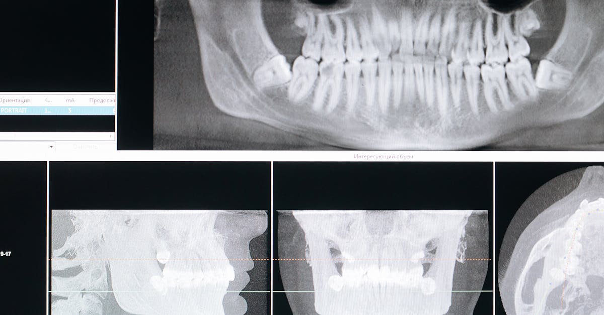 découvrez tout ce qu'il faut savoir sur le muguet buccal : symptômes, causes, prévention et traitements efficaces pour soigner cette infection buccale d'origine fongique.