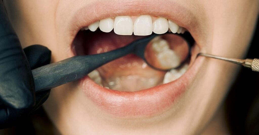 découvrez tout ce qu'il faut savoir sur le muguet buccal : causes, symptômes, traitements efficaces et conseils pour prévenir cette infection fongique fréquente de la bouche.