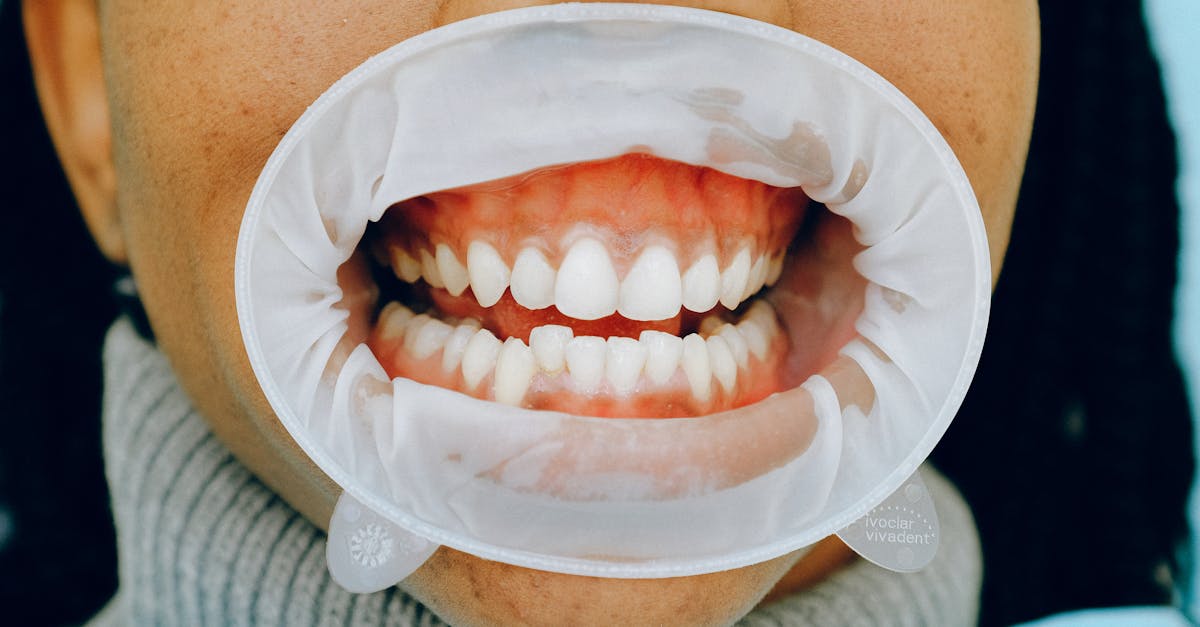 découvrez tout ce qu'il faut savoir sur le muguet buccal : causes, symptômes, traitements efficaces et conseils pour prévenir cette infection courante de la bouche chez l'adulte et l'enfant.